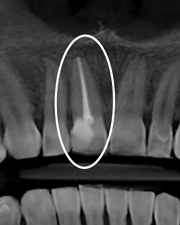 dental-root-canal-definition-necessity-procedure-and-treatment