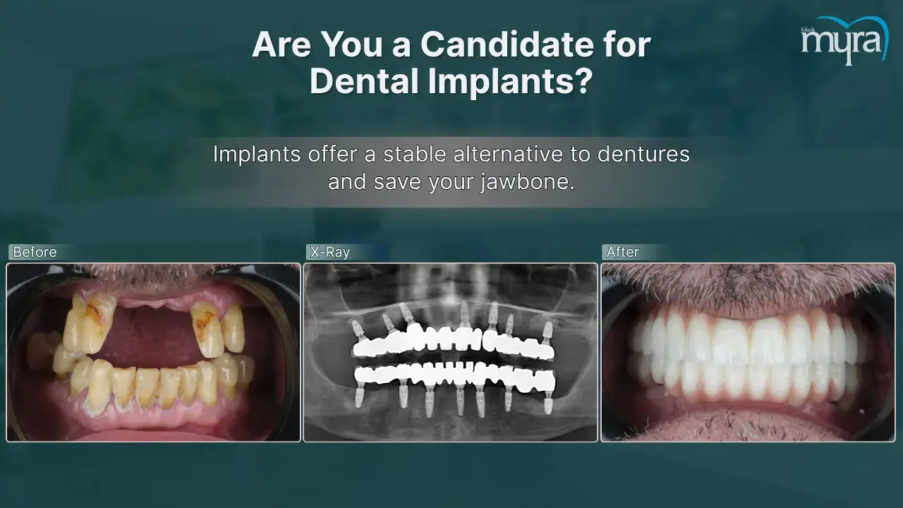 who-needs-a-dental-implant