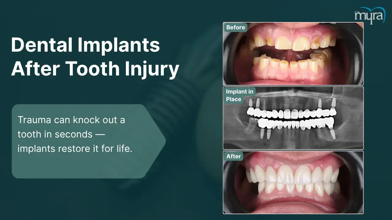 3-tooth-loss-from-injury