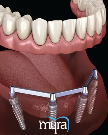 dental-implant-overdentures-definition-types-benefits-and-cost