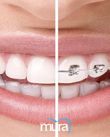 orthodontics-definition-types-benefits-and-cost