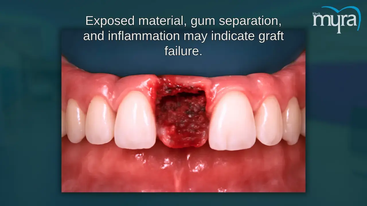 what-are-the-signs-of-bone-graft-complications