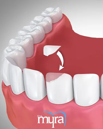 dental-bonding-definition-types-cost-and-recovery-duration