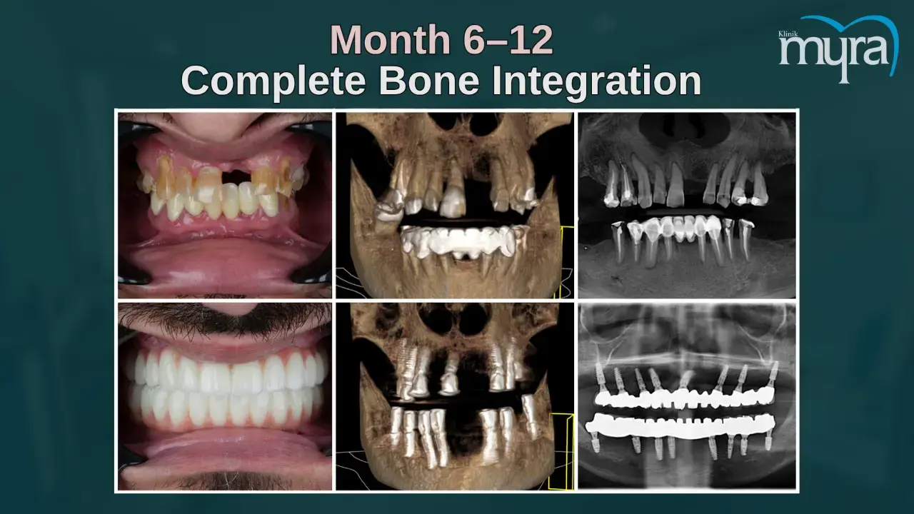 5-full-bone-integration-6-months-1-year