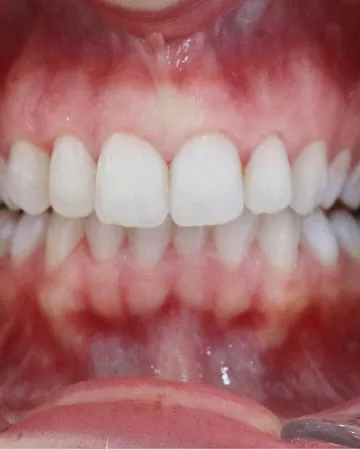 5-risks-and-considerations-of-teeth-whitening-what-you-should-know,