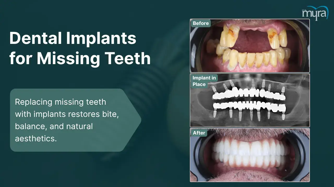 1-missing-teeth-single-or-multiple