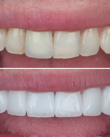 Dental Crown Definition Importance Types Procedure and Advantages,