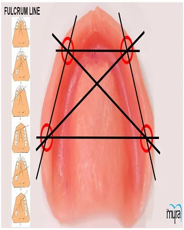 a-complete-understanding-of-all-on-4-dental-implant