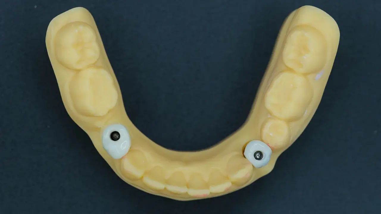 who-can-use-custom-made-abutments