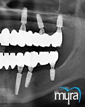 Cost-of-Dental-Implant