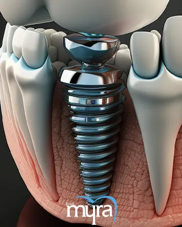 10-benefits-of-dental-implants