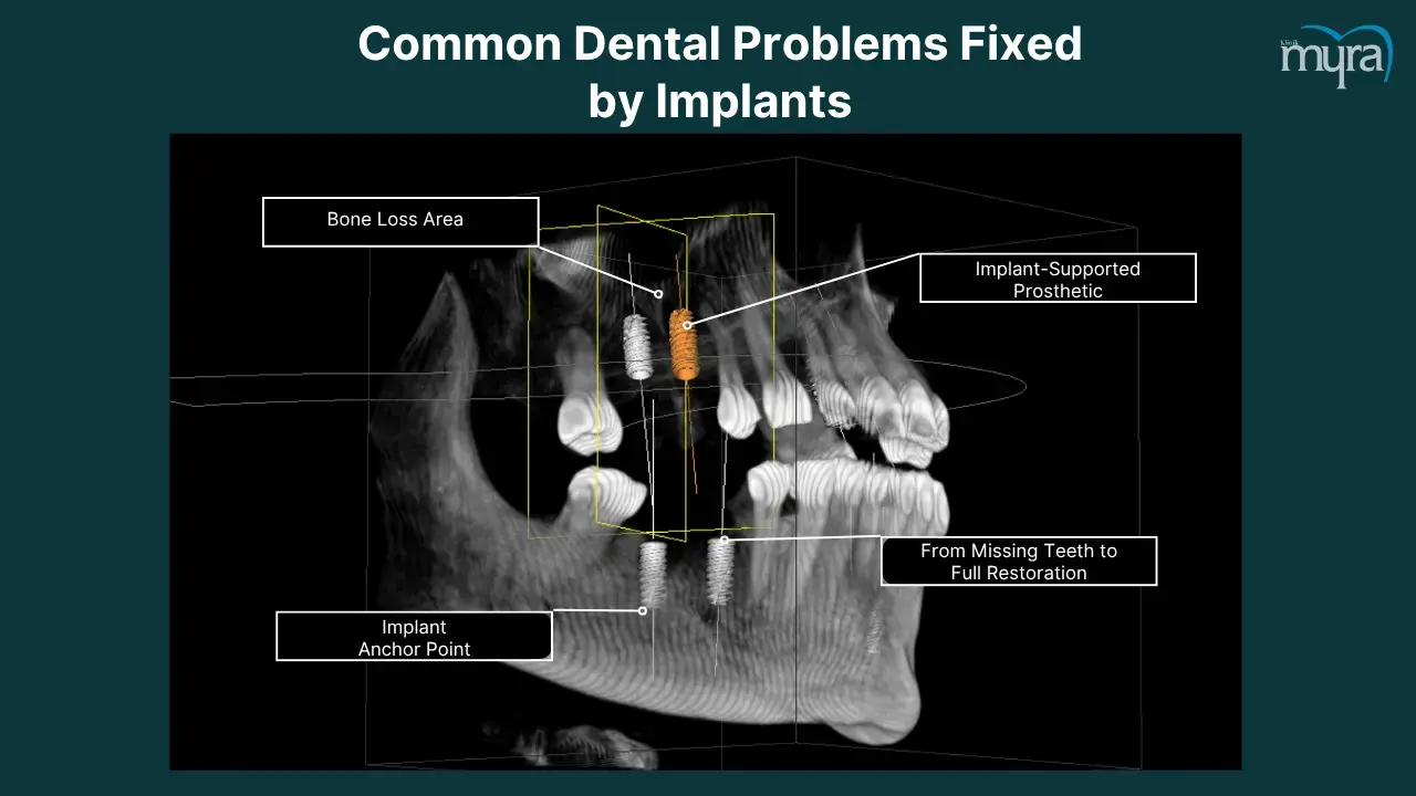 what-common-dental-problems-can-be-fixed-by-dental-implant