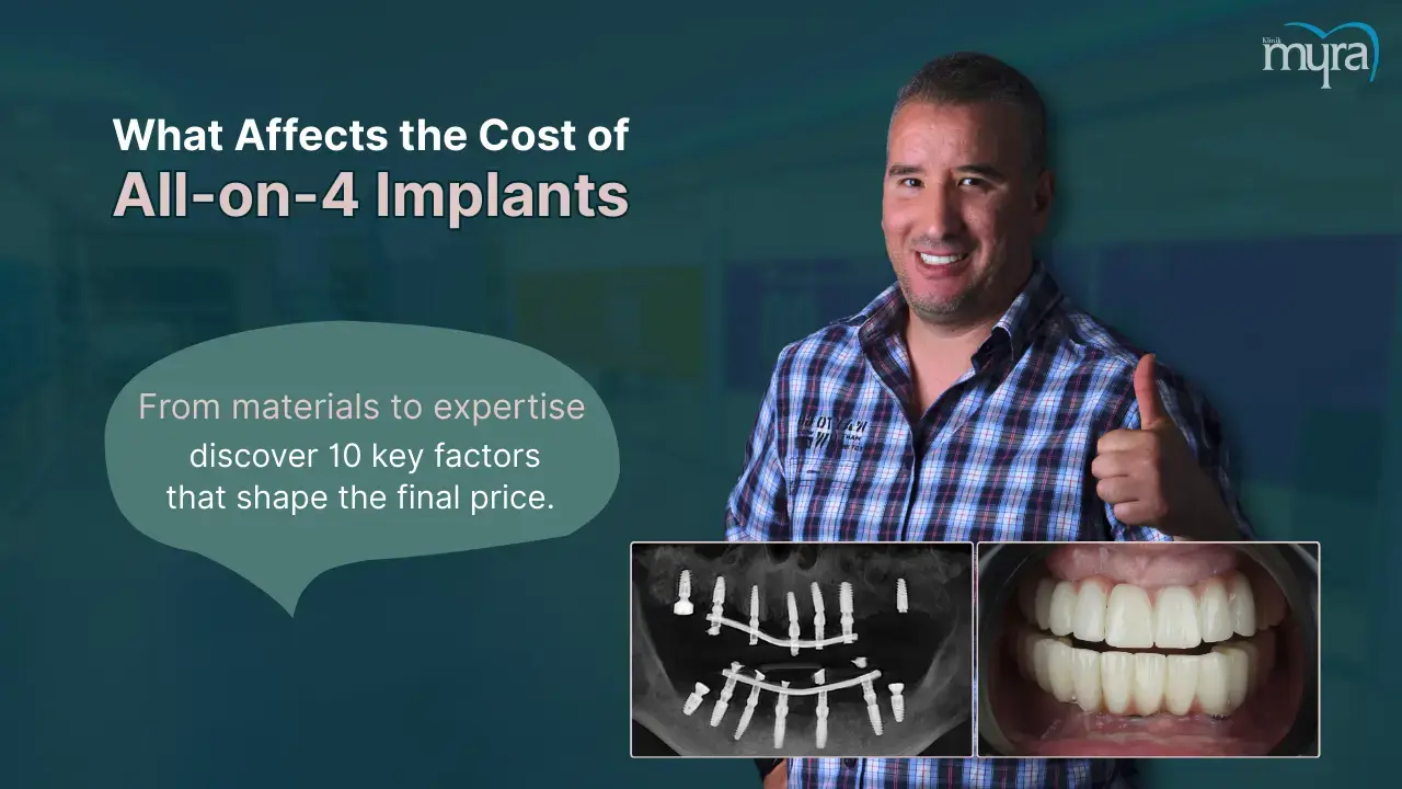 what-are-the-factors-affecting-the-cost-of-all-on-4-implants