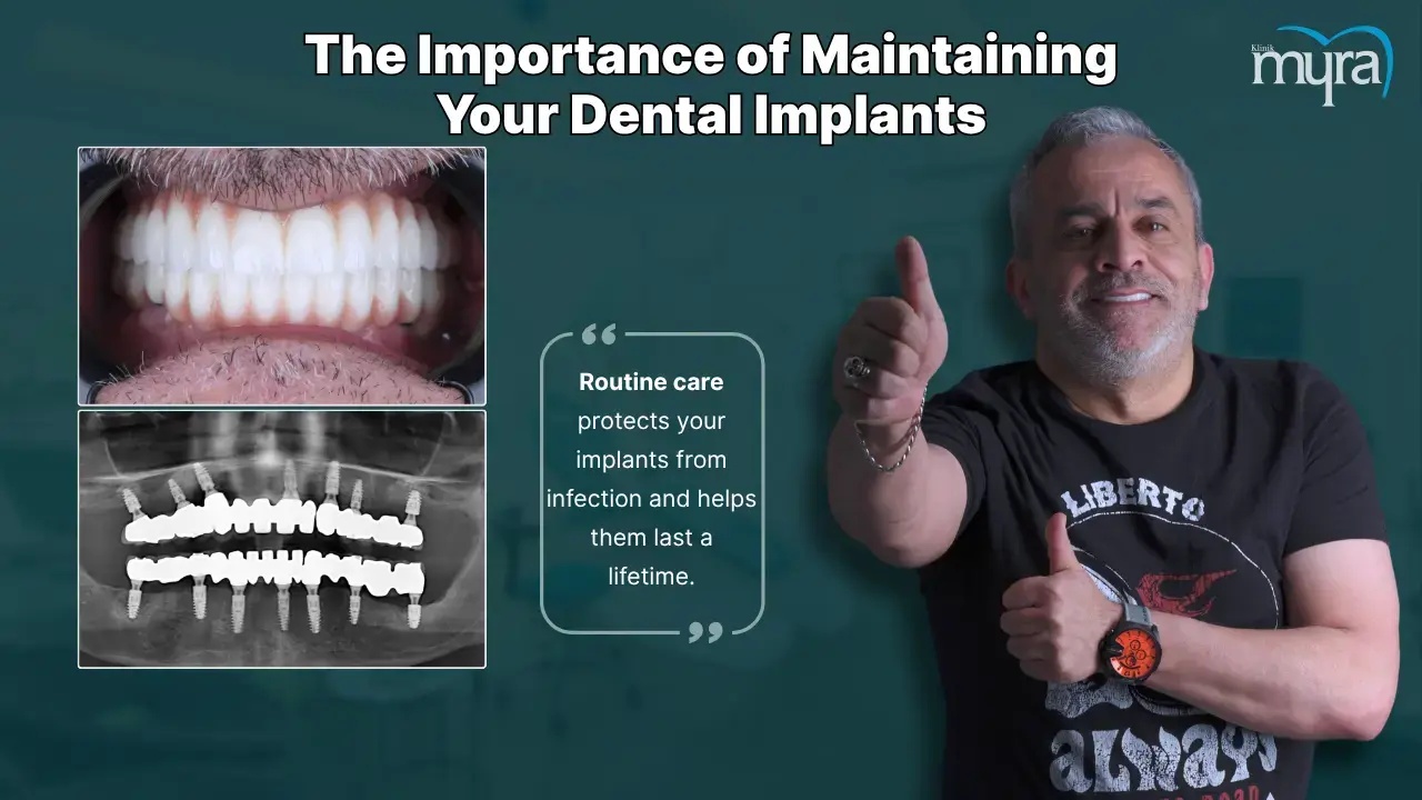 why-dental-implant-maintenance-is-important