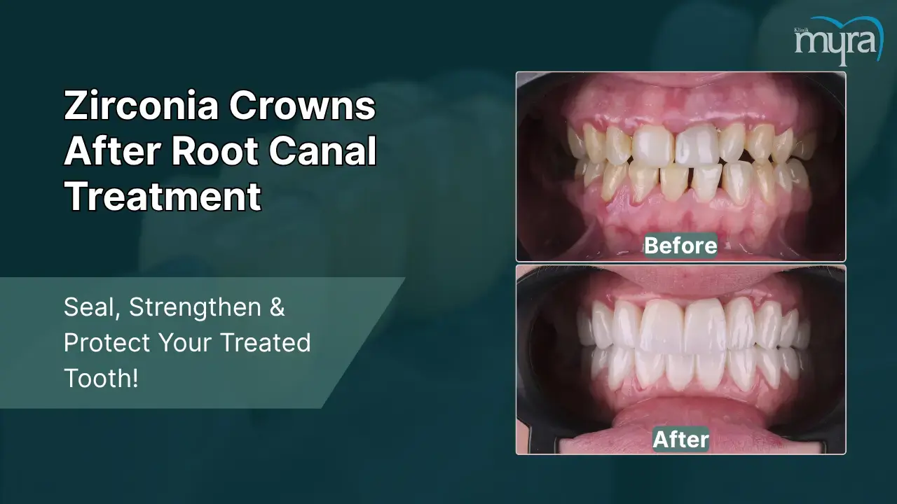 8-post-root-canal-protection