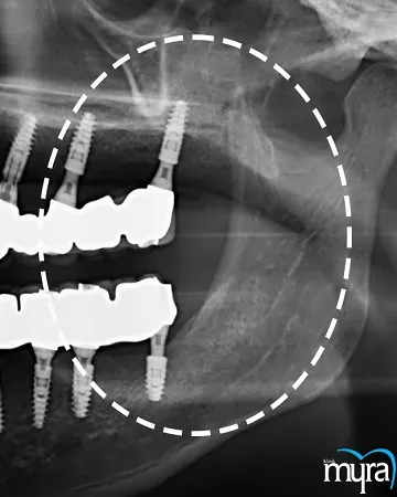 xenograft-tissue-definition-benefits-cost-and-recovery-duration,