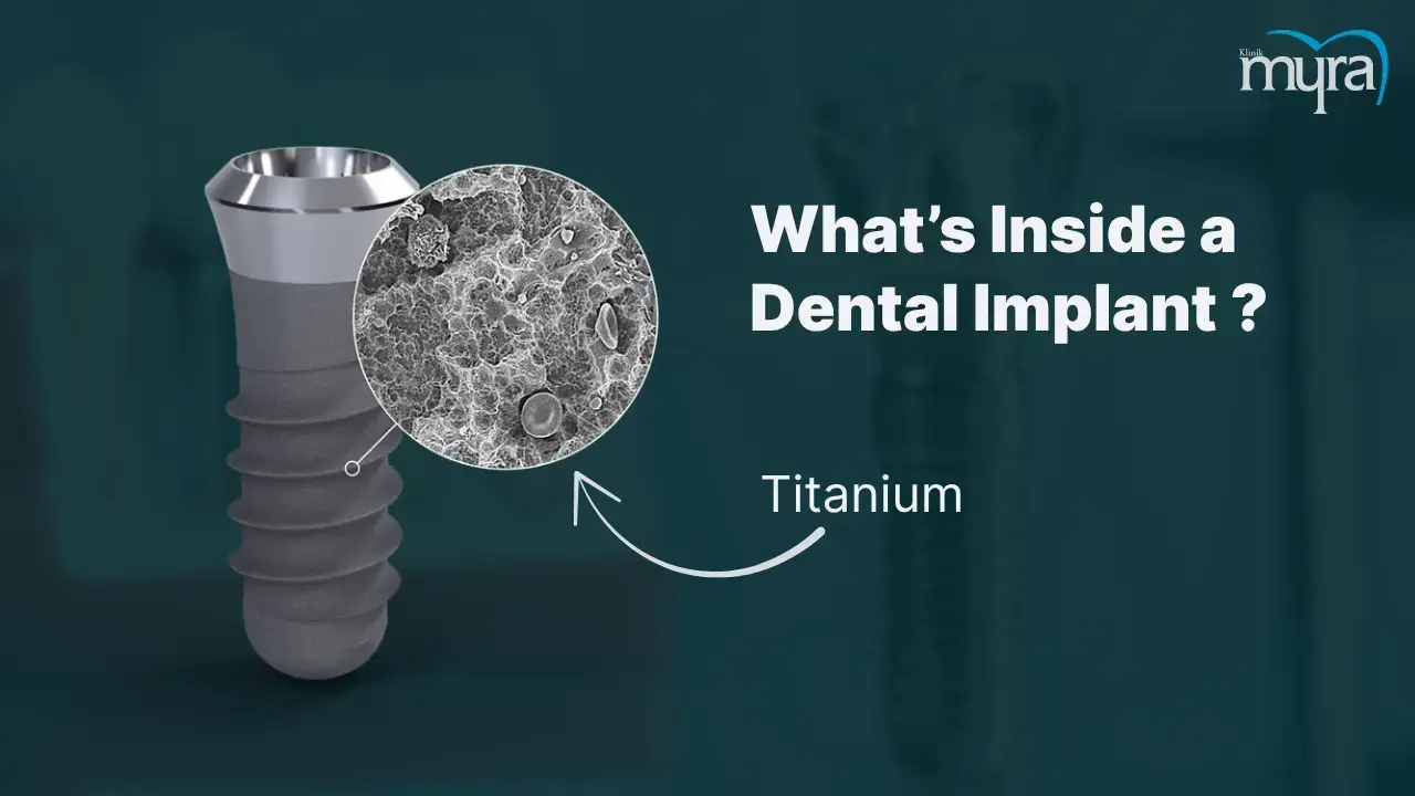 how-do-dental-implants-work