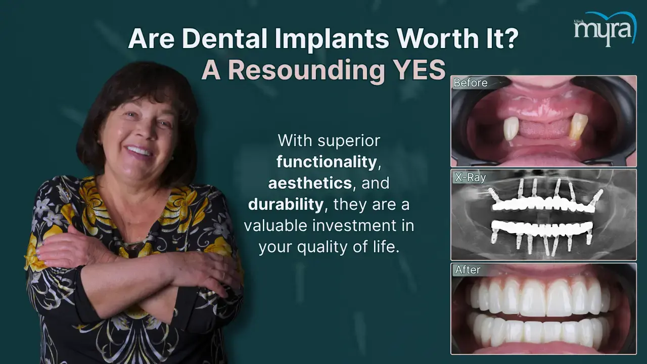 what-are-the-alternatives-of-dental-implants
