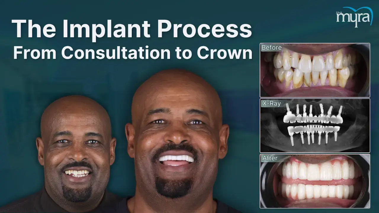 what-is-the-tooth-implant-treatment-process