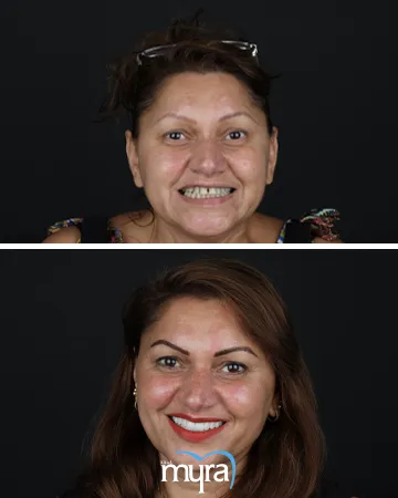 nasolabial-folds-definition-types-treatment-cost-and-recovery-duration,