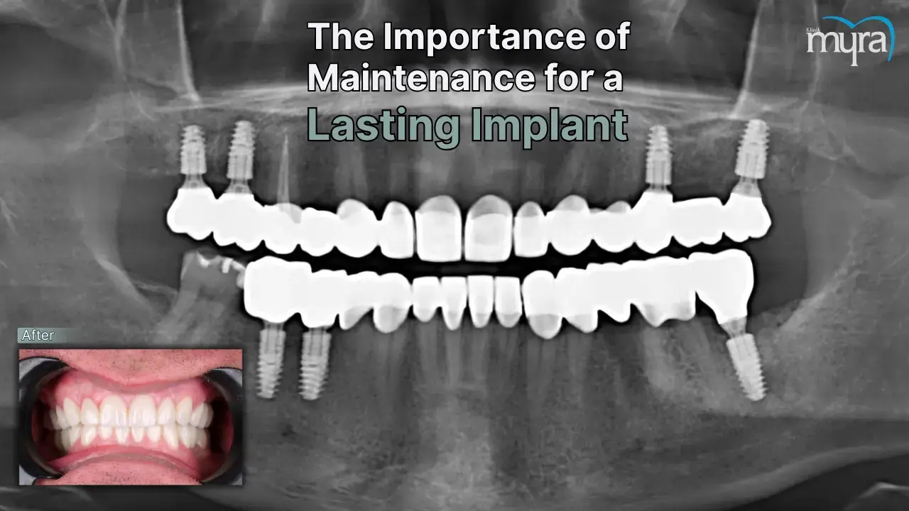 how-is-dental-implant-maintenance-done