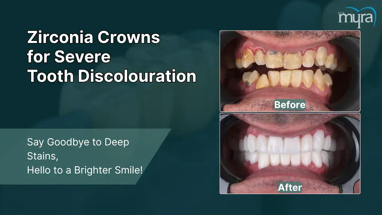 1-severe-discolouration