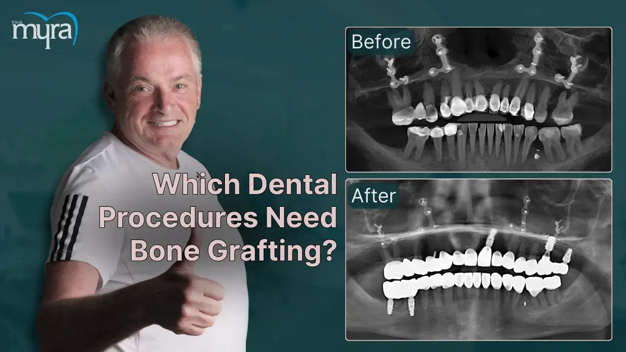 what-dental-treatments-require-bone-grafting