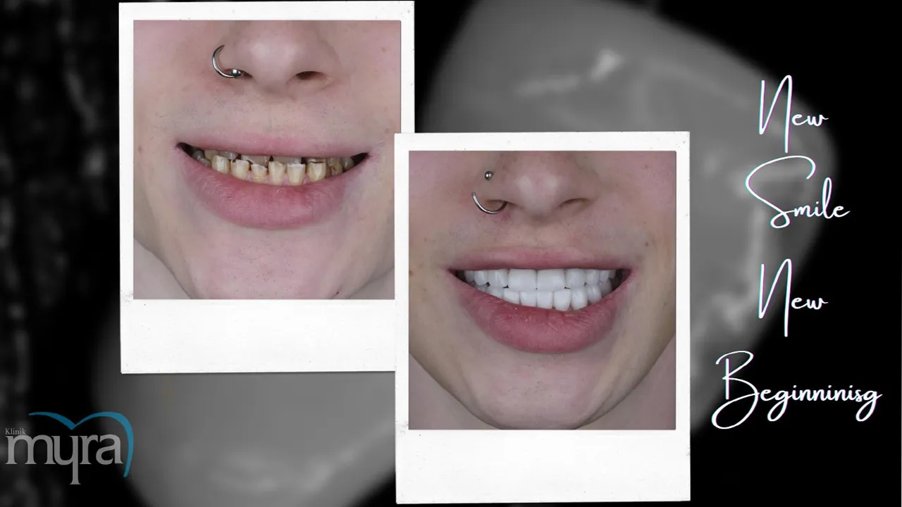 7-benefits-of-teeth-whitening