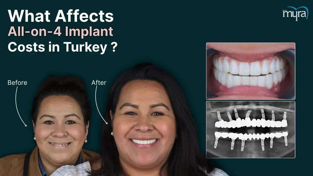 what-are-the-factors-affecting-the-cost-of-all-on-4-implants-in-turkey