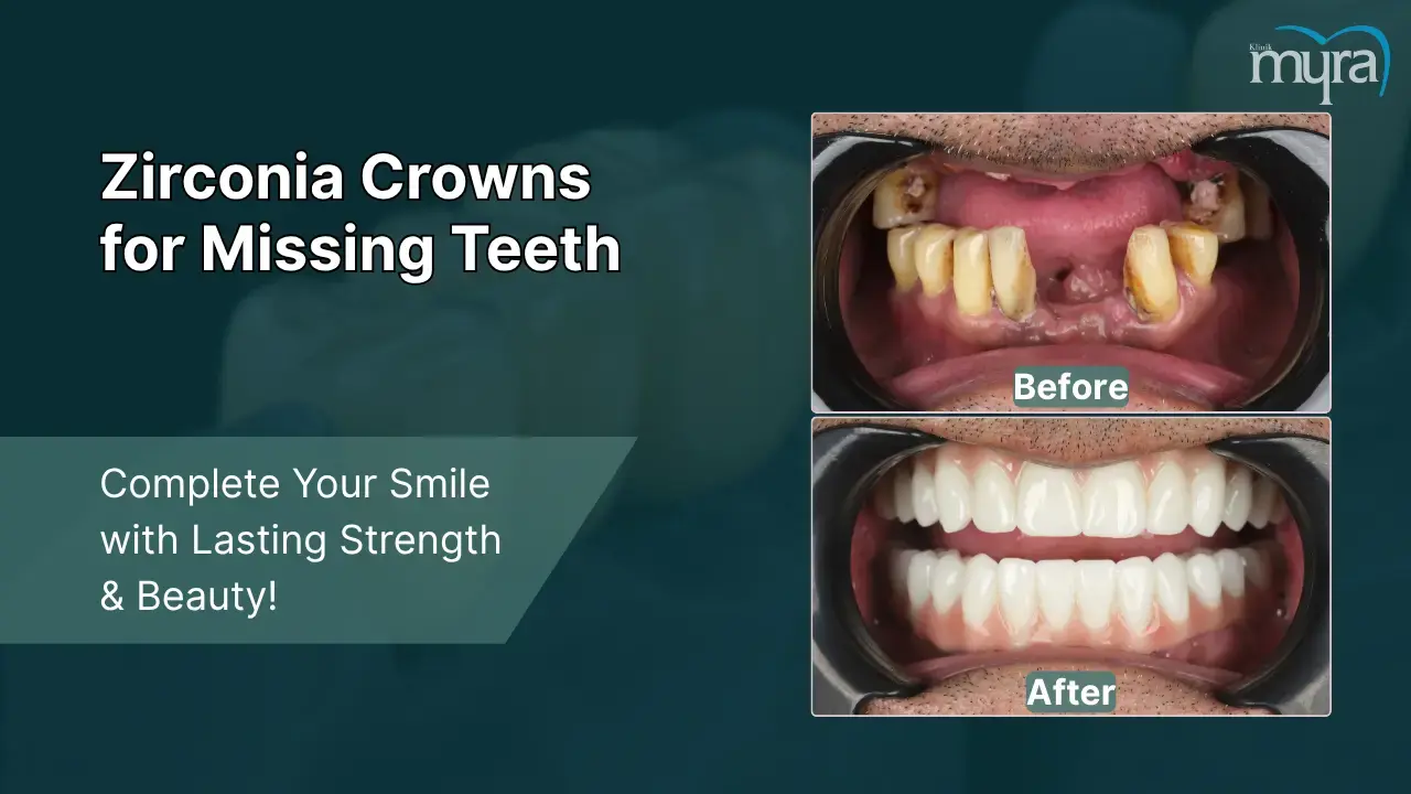 6-missing-teeth-implants-or-bridges