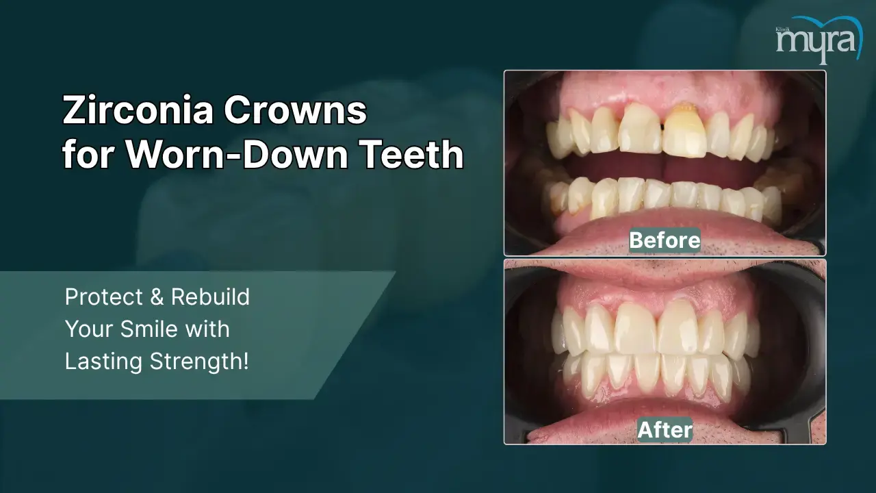 3-worn-down-teeth