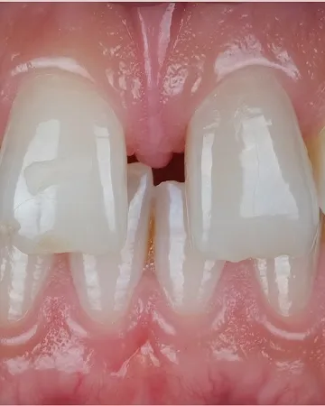 malocclusion-of-the-teeth-definition-causes-and-types,