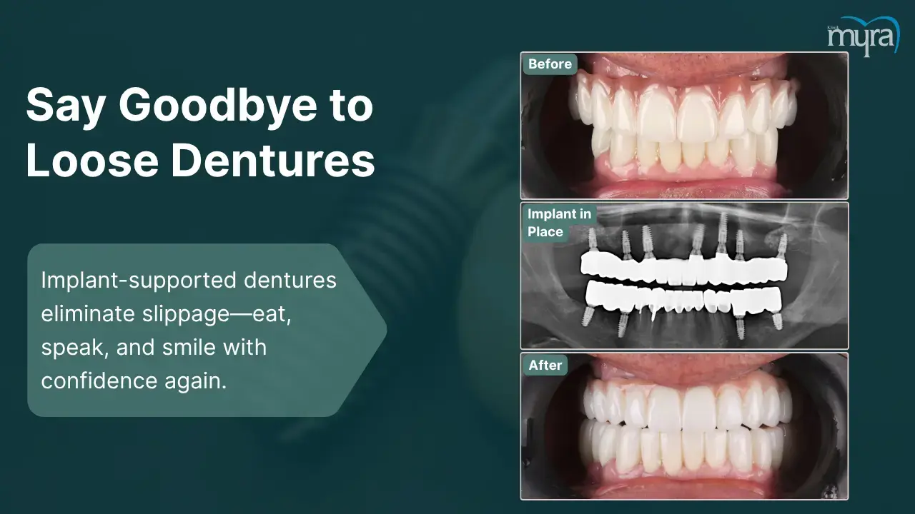 6-loose-or-unstable-dentures