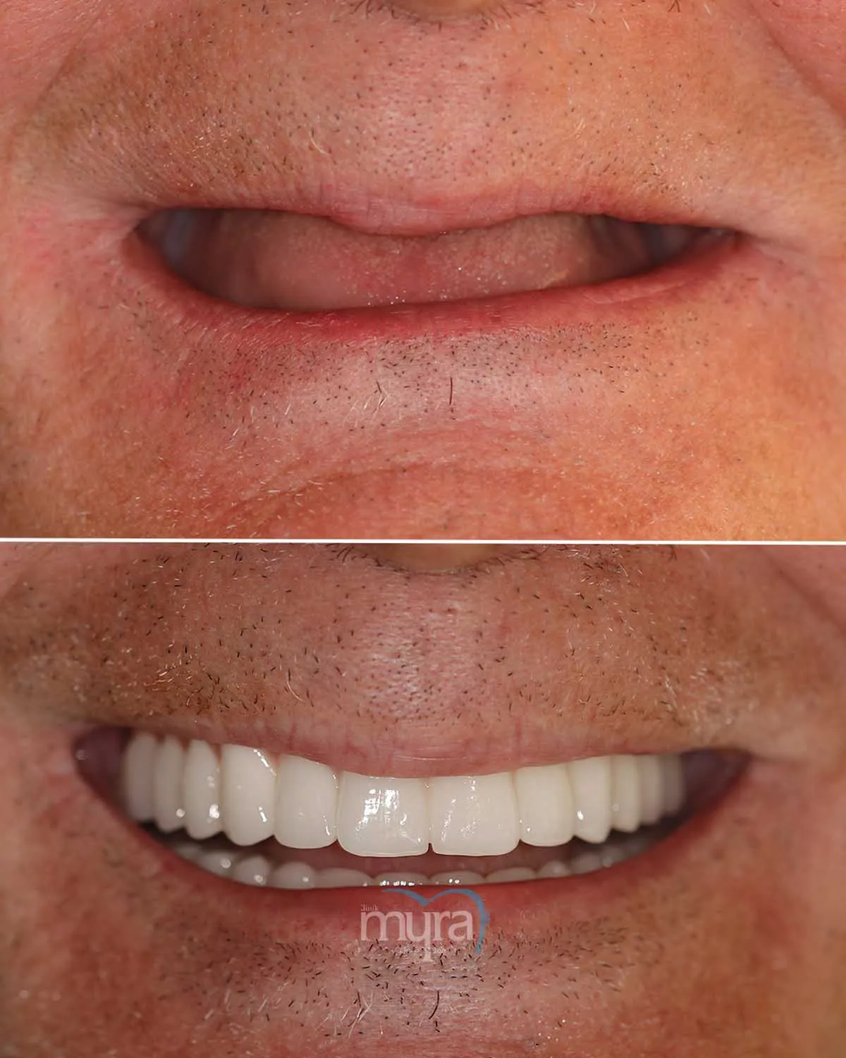 all-on-4-dental-implants-in-turkey