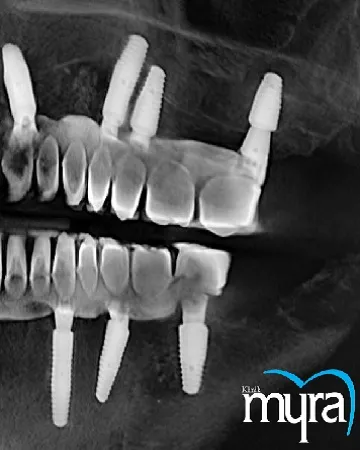 8-dental-implant-surgery-techniques