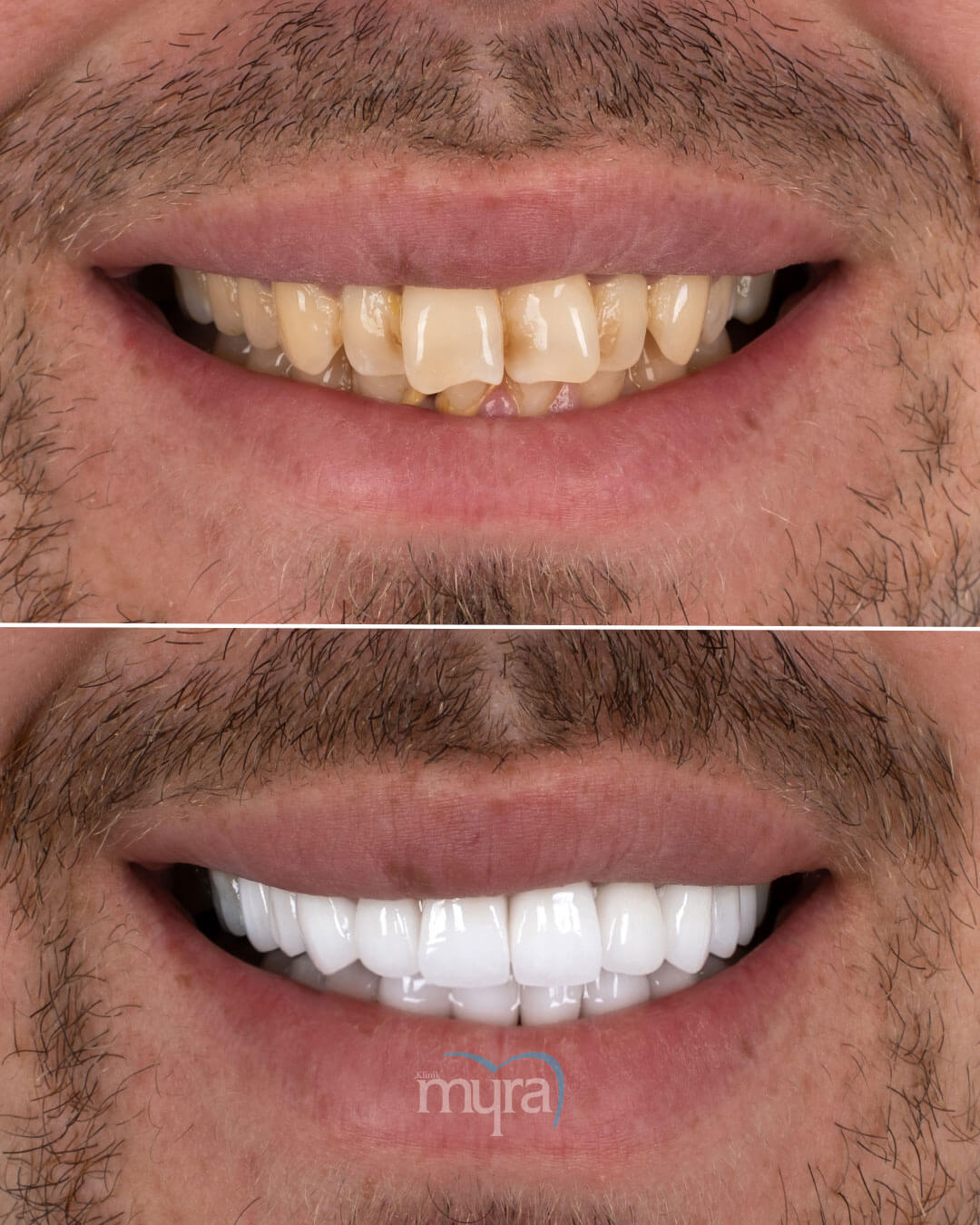 Full Set of Veneers and Crowns- Dental Clinic Turkey