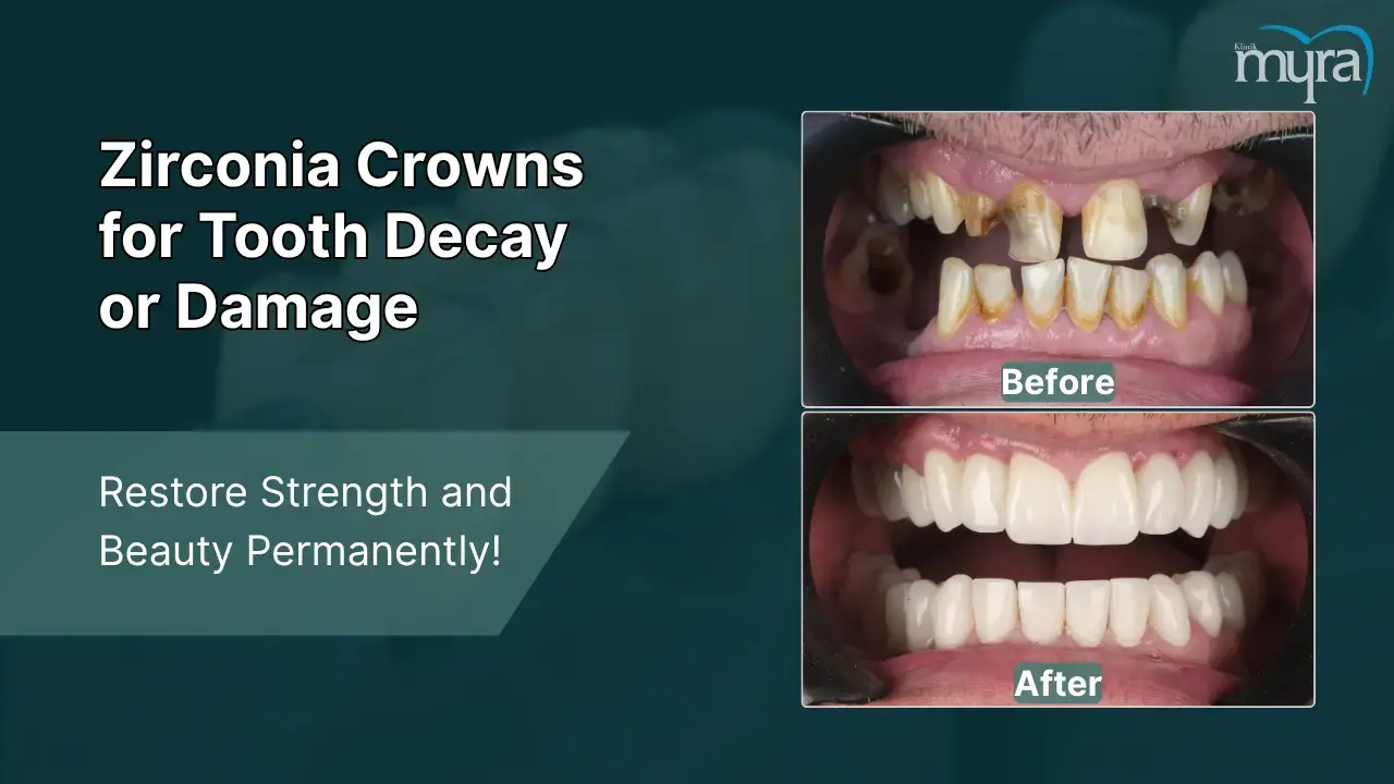 5-tooth-decay-or-damage