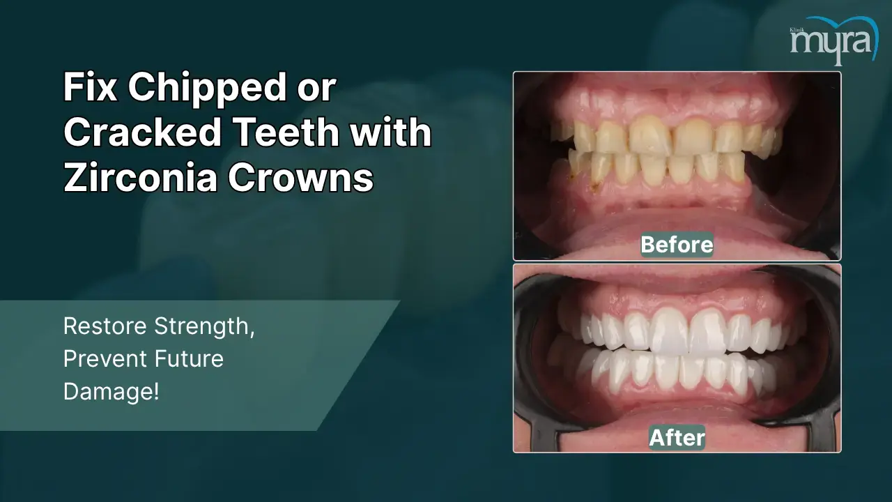 2-chipped-or-cracked-teeth