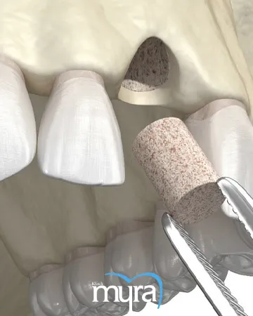 dental-bone-grafting-types-process-and-healing-duration,