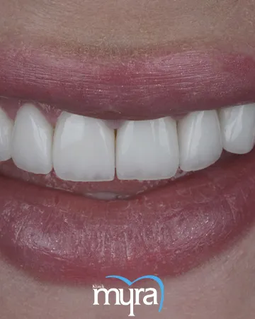 dental-veneers-definition-types-cost-and-recovery-duration