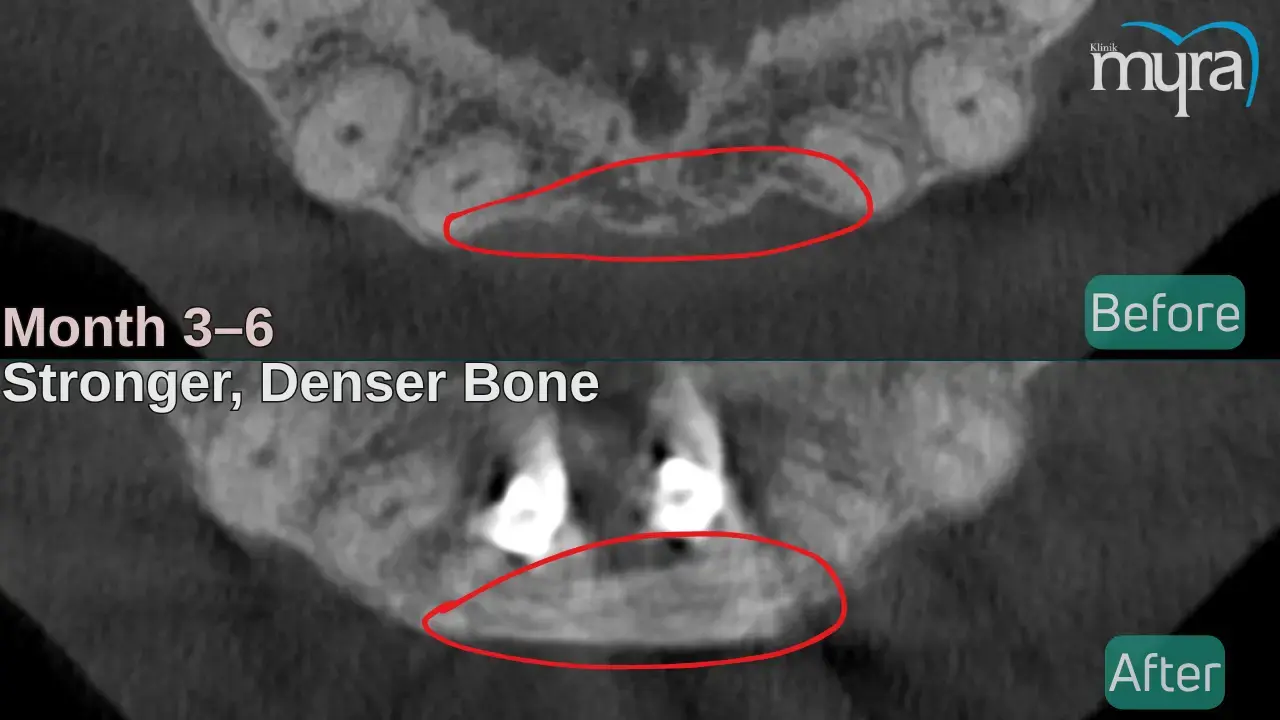 4-bone-maturation-3-6-months