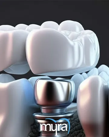 dental-implant-abutment-definition-uses-types-and-procedures