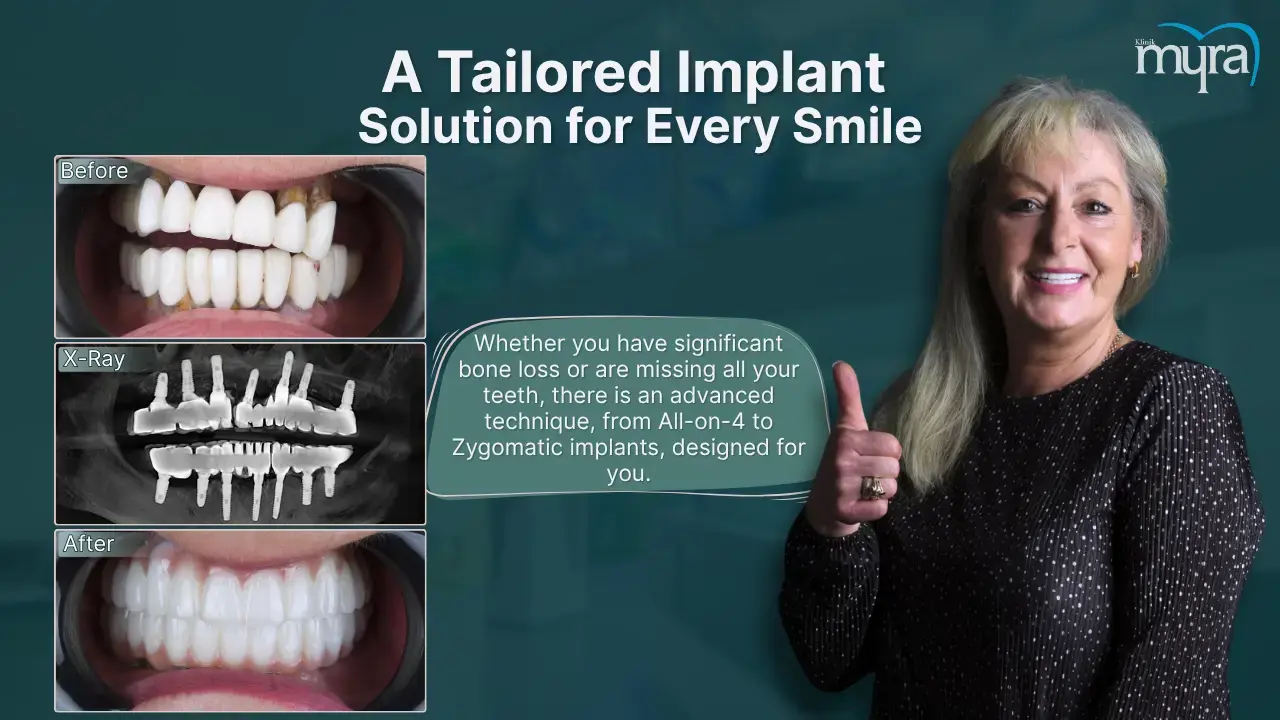 what-are-the-different-dental-implant-techniques