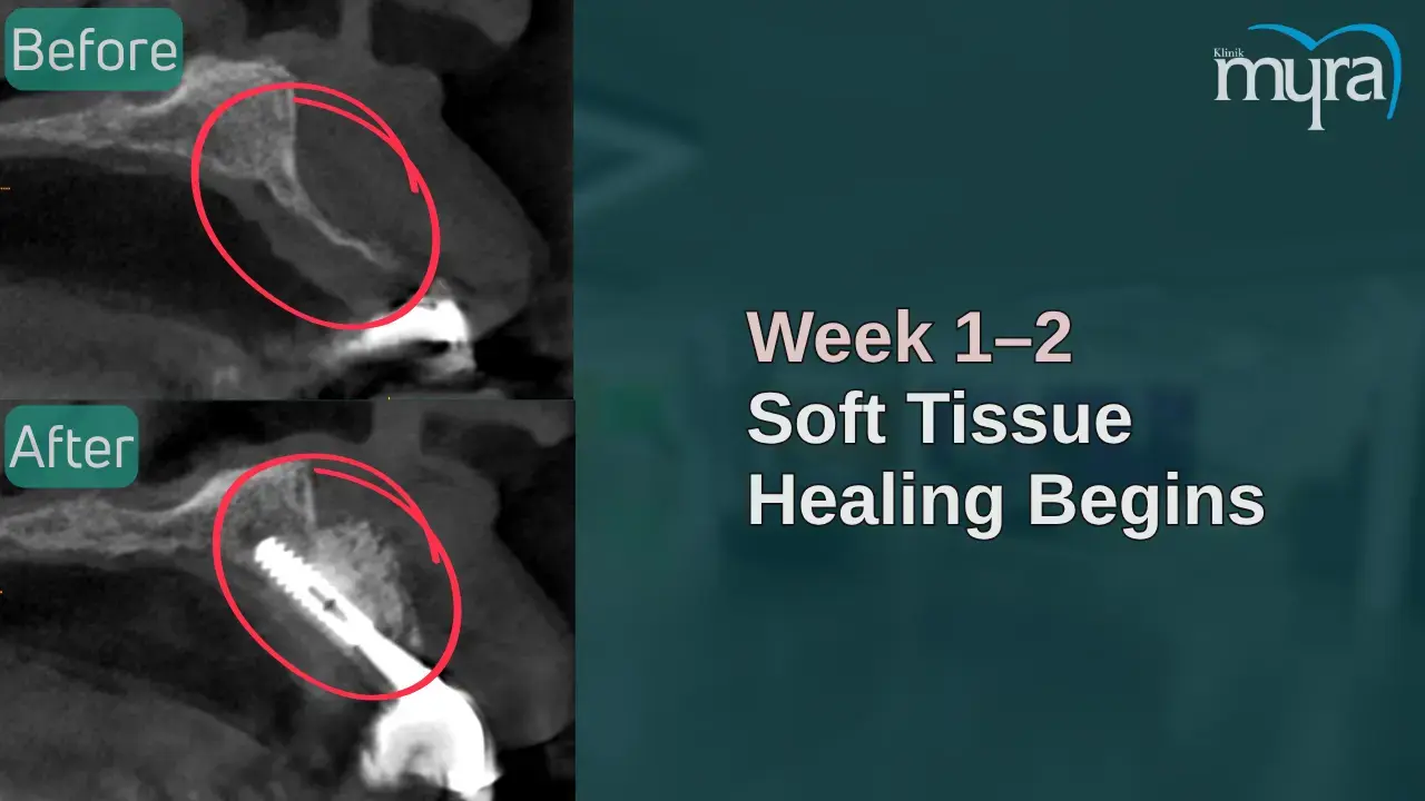 2-initial-healing-and-blood-clot-formation-1-2-weeks