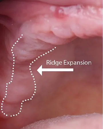 Ridge-Expansion-Definition