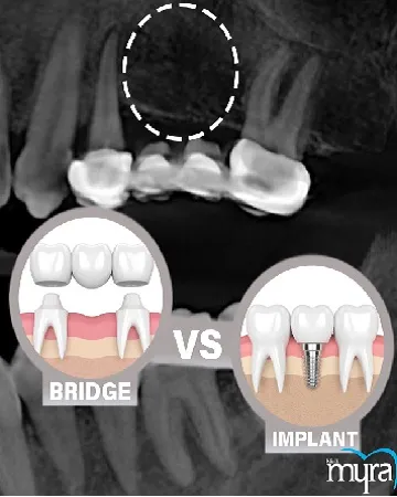 single-tooth-dental-implant-definition-benefits-procedure-and-average-cost