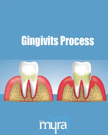 Gingivitis-Definition,