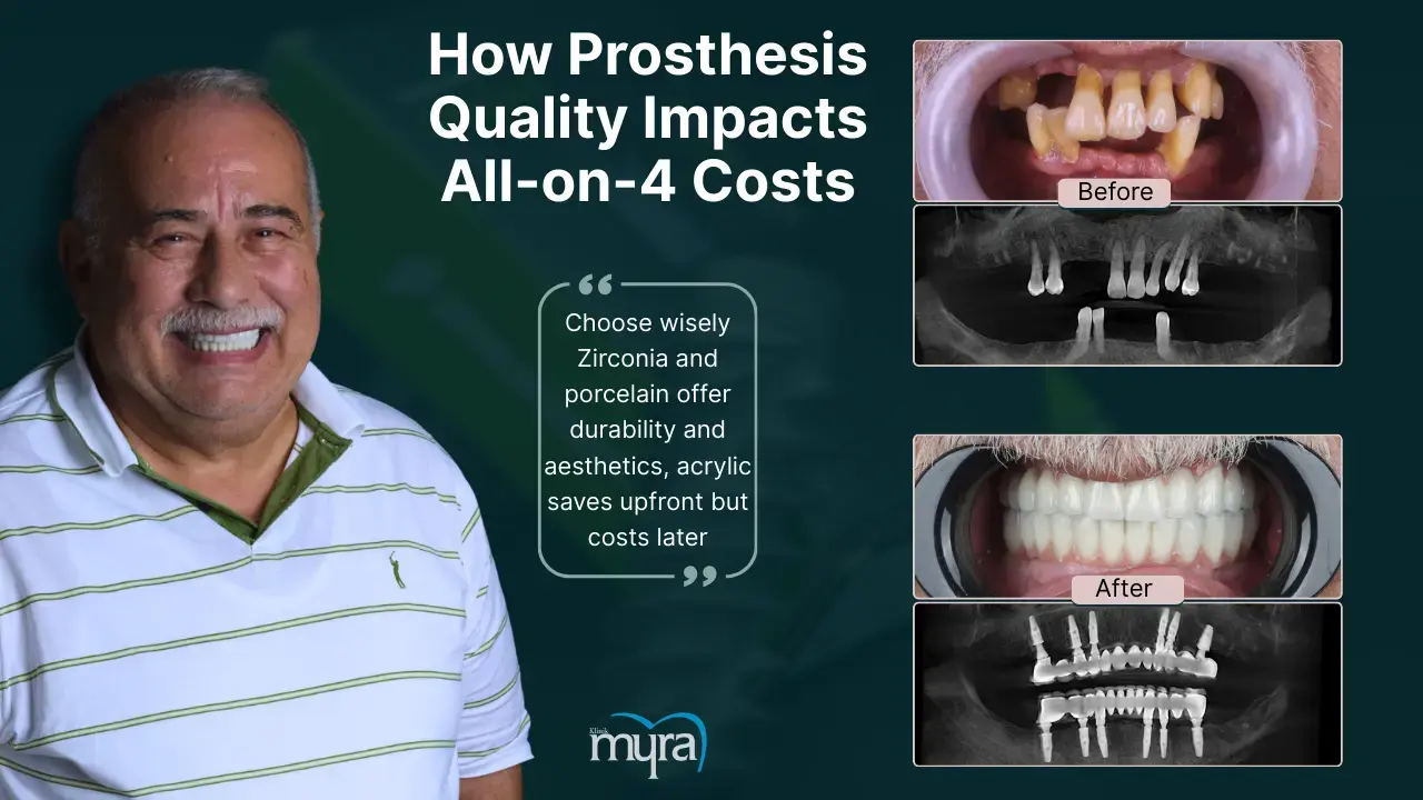what-are-the-factors-affecting-the-cost-of-all-on-4-implants-in-turkey