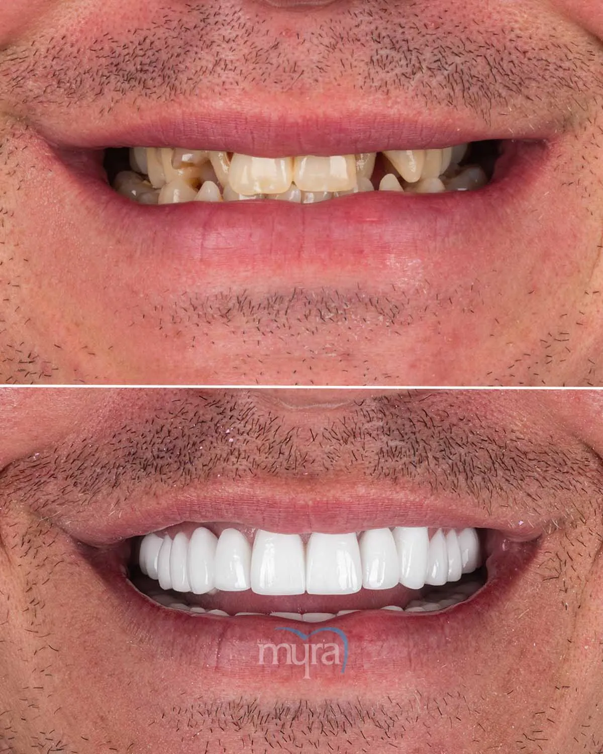 Brightening Dental Implants How to Whiten Dental Implant?,