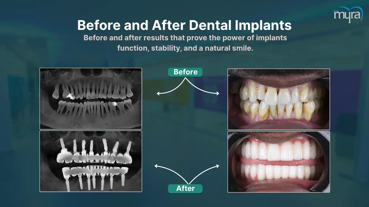 full-mouth-dental-implants-before-and-after